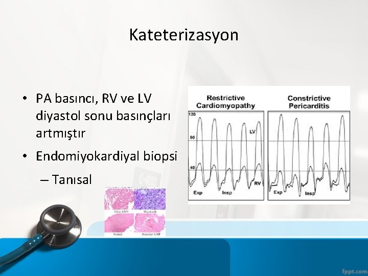 Kateterizasyon • PA basıncı, RV ve LV diyastol sonu basınçları artmıştır • Endomiyokardiyal biopsi