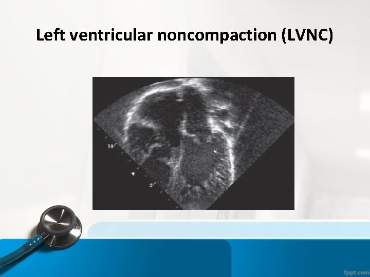Left ventricular noncompaction (LVNC) 