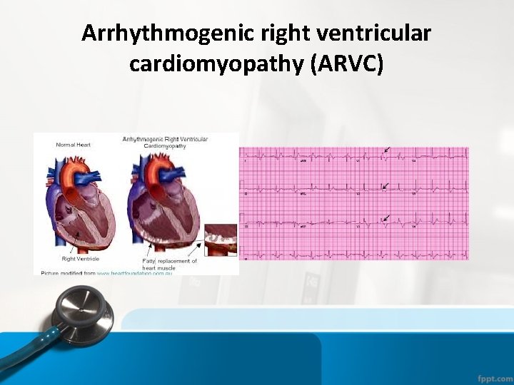 Arrhythmogenic right ventricular cardiomyopathy (ARVC) 