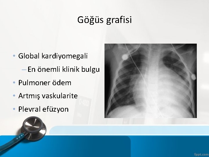 Göğüs grafisi • Global kardiyomegali – En önemli klinik bulgu • Pulmoner ödem •