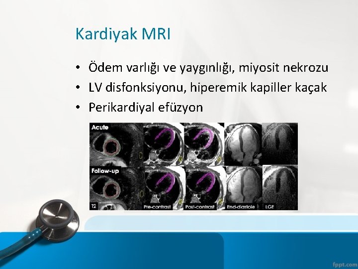 Kardiyak MRI • Ödem varlığı ve yaygınlığı, miyosit nekrozu • LV disfonksiyonu, hiperemik kapiller