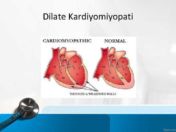 Dilate Kardiyomiyopati 