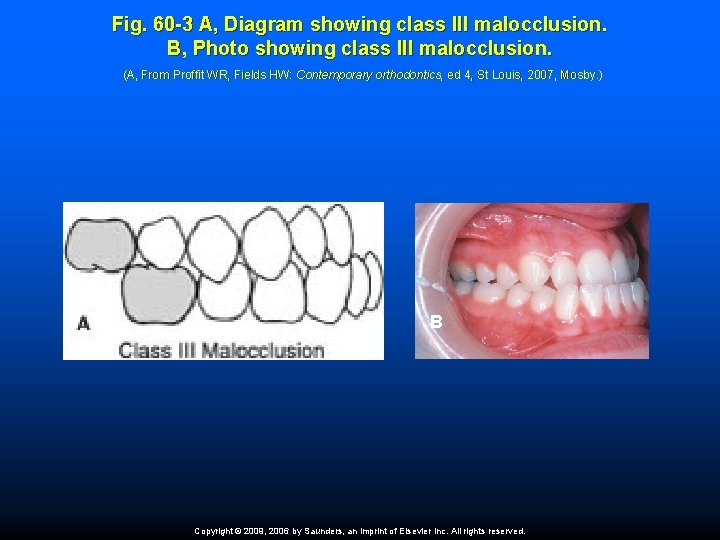 Fig. 60 -3 A, Diagram showing class III malocclusion. B, Photo showing class III