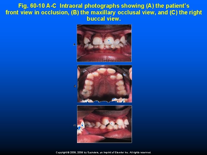 Fig. 60 -10 A-C Intraoral photographs showing (A) the patient’s front view in occlusion,