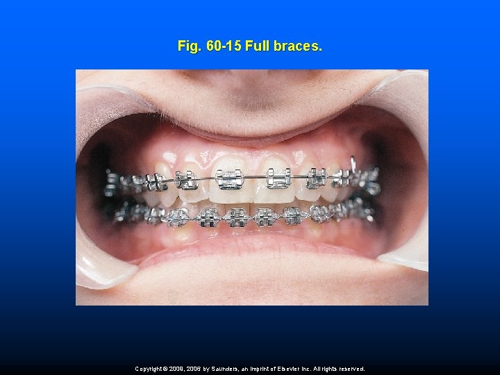 Fig. 60 -15 Full braces. Copyright © 2009, 2006 by Saunders, an imprint of