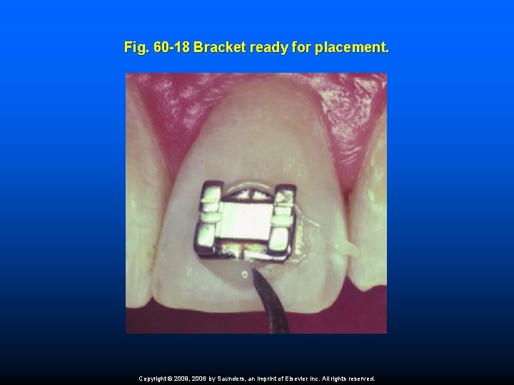 Fig. 60 -18 Bracket ready for placement. Copyright © 2009, 2006 by Saunders, an