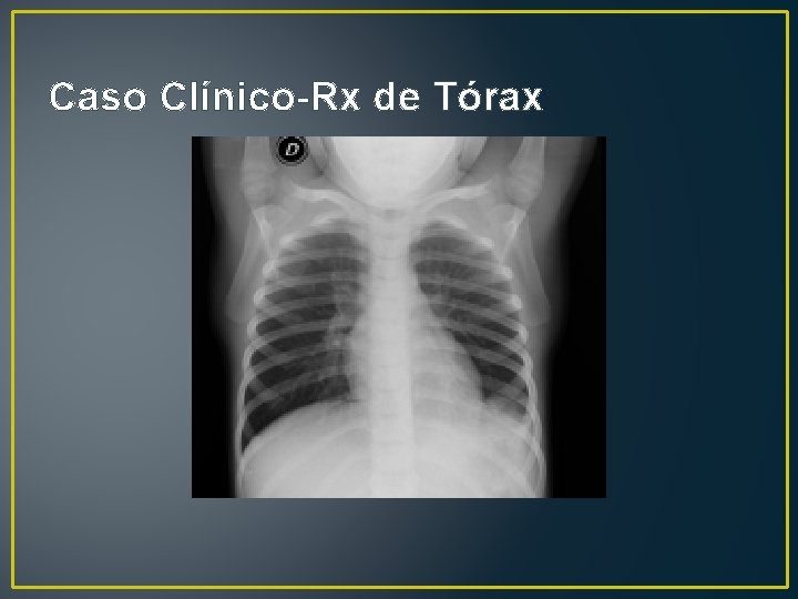 Caso Clínico-Rx de Tórax 