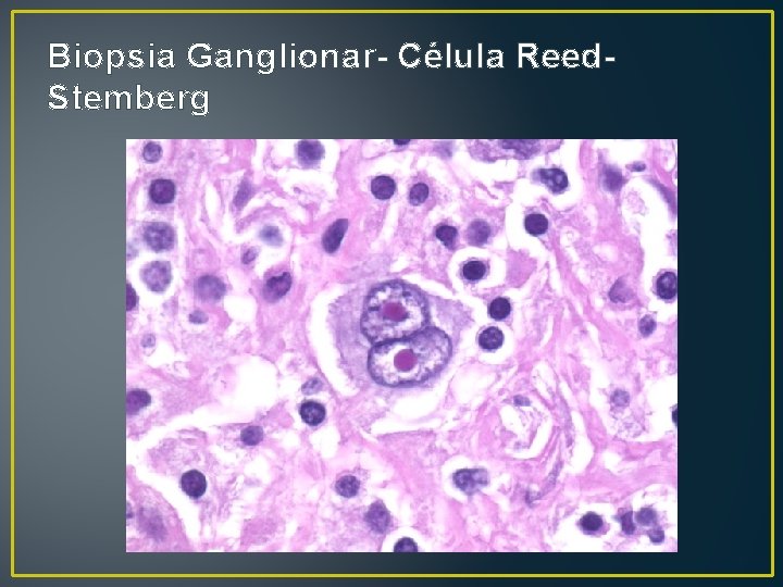 Biopsia Ganglionar- Célula Reed. Stemberg 