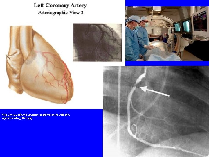 http: //www. columbiasurgery. org/divisions/cardiac/im ages/novartis_207 B. jpg 