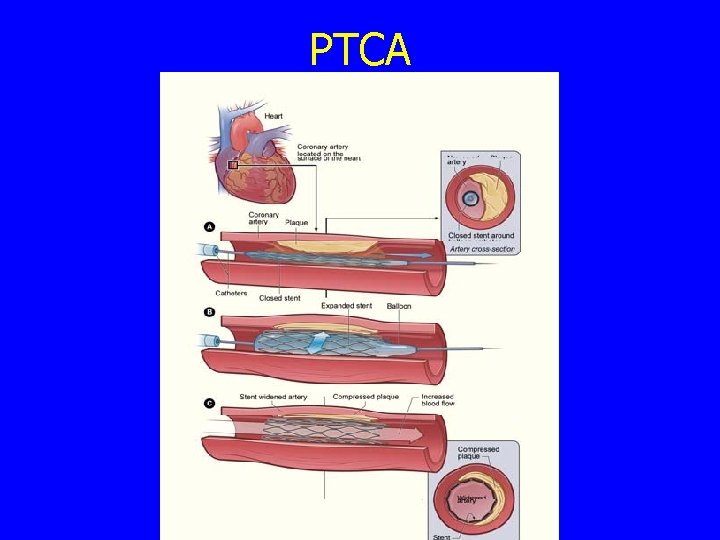 PTCA 