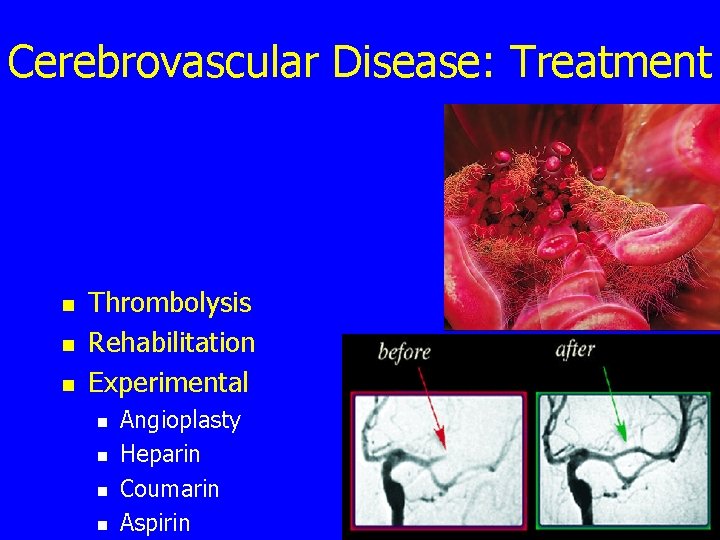 Cerebrovascular Disease: Treatment n n n Thrombolysis Rehabilitation Experimental n n Angioplasty Heparin Coumarin