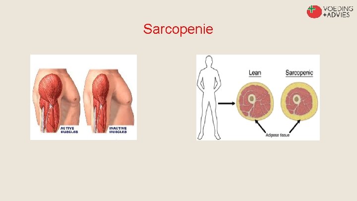 Sarcopenie 