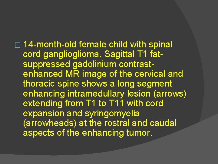 � 14 -month-old female child with spinal cord ganglioma. Sagittal T 1 fatsuppressed gadolinium