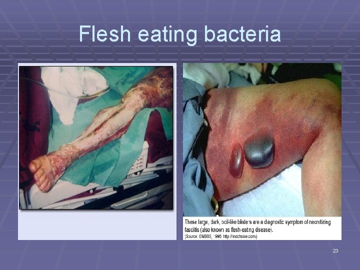 Flesh eating bacteria 23 