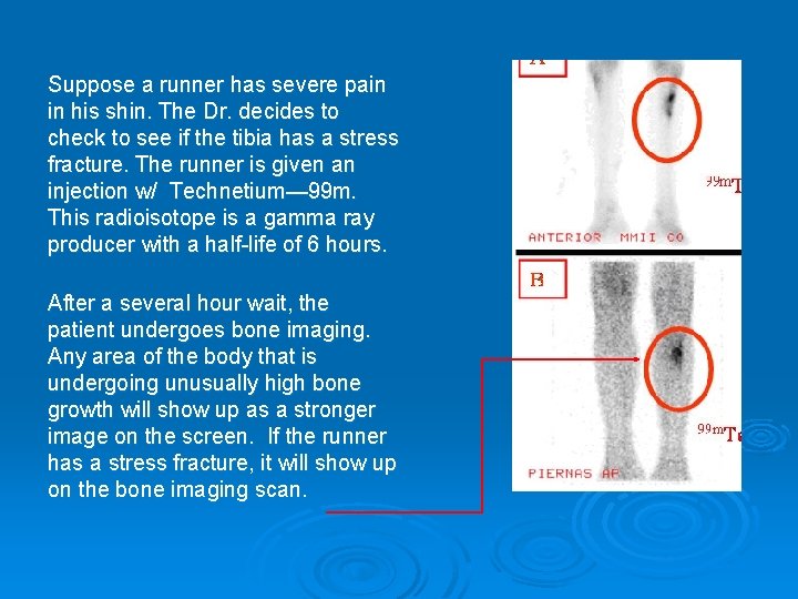 Suppose a runner has severe pain in his shin. The Dr. decides to check