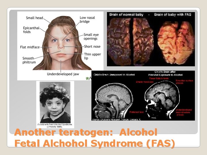 Another teratogen: Alcohol Fetal Alchohol Syndrome (FAS) 