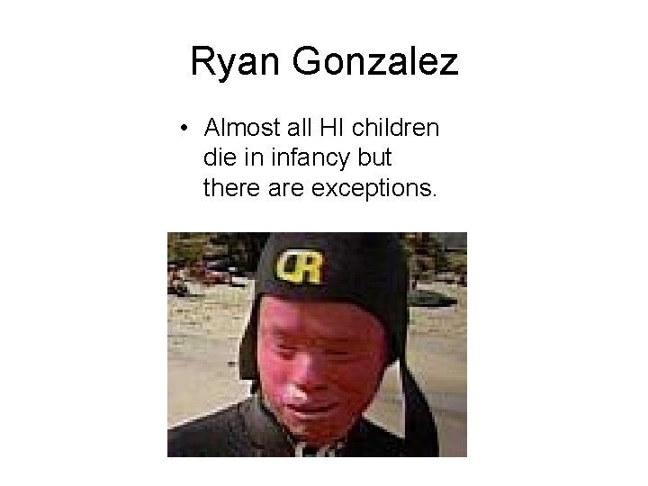 Ryan Gonzalez • Almost all HI children die in infancy but there are exceptions.