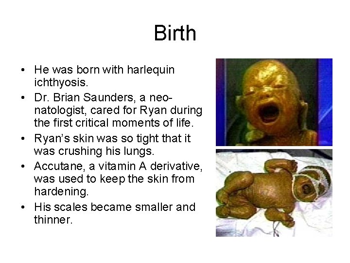 Birth • He was born with harlequin ichthyosis. • Dr. Brian Saunders, a neonatologist,