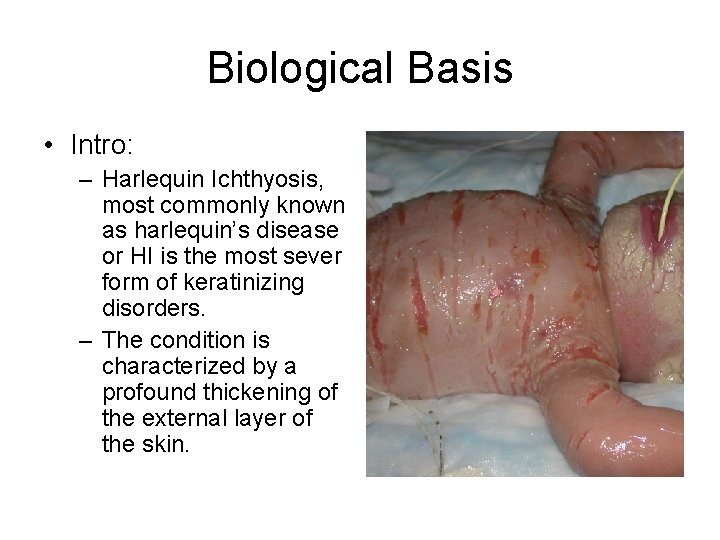 Biological Basis • Intro: – Harlequin Ichthyosis, most commonly known as harlequin’s disease or