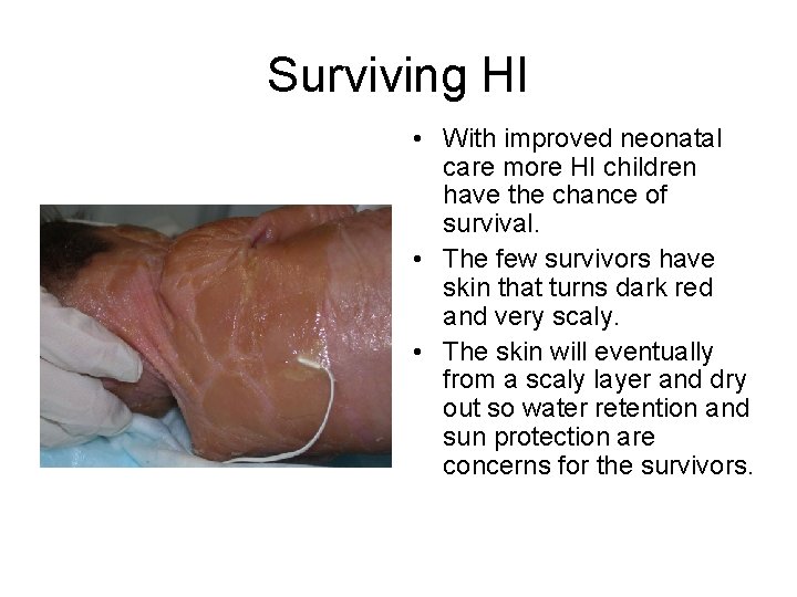 Surviving HI • With improved neonatal care more HI children have the chance of