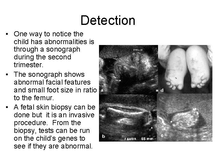 Detection • One way to notice the child has abnormalities is through a sonograph