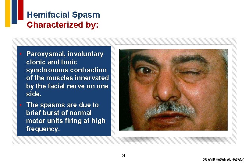Hemifacial Spasm Characterized by: • Paroxysmal, involuntary clonic and tonic synchronous contraction of the
