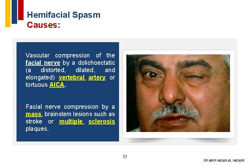 Hemifacial Spasm Causes: • Vascular compression of the facial nerve by a dolichoectatic (a