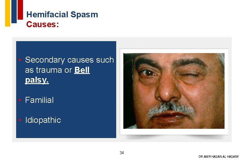Hemifacial Spasm Causes: • Secondary causes such as trauma or Bell palsy. • Familial