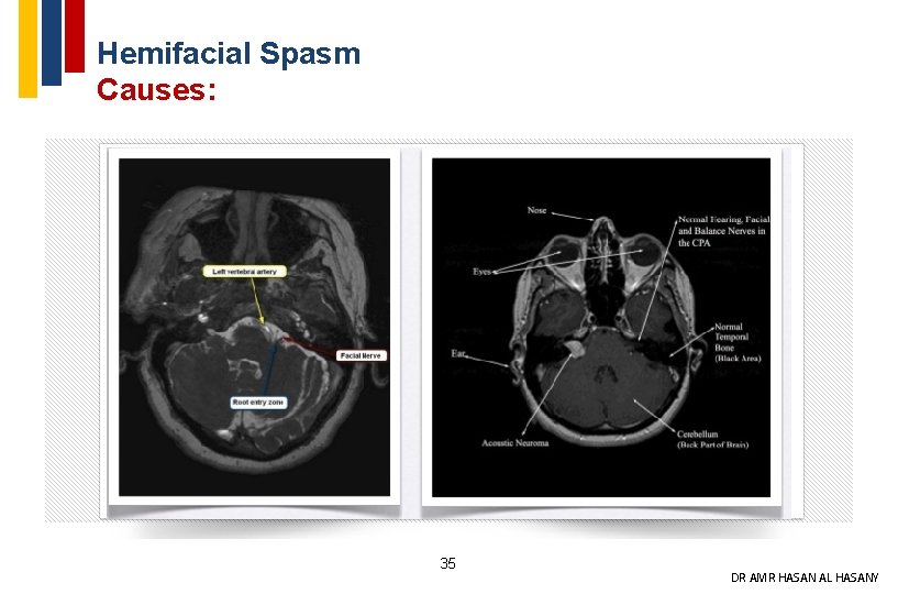 Hemifacial Spasm Causes: 35 DR AMR HASAN AL HASANY 