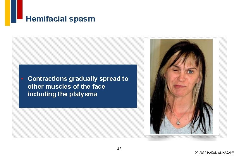 Hemifacial spasm • Contractions gradually spread to other muscles of the face including the