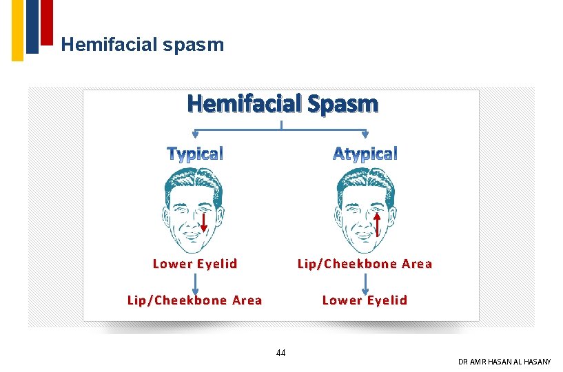 Hemifacial spasm Hemifacial Spasm Lower Eyelid Lip/Cheekbone Area Lower Eyelid 44 DR AMR HASAN