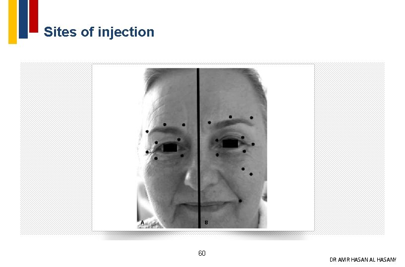 Sites of injection 60 DR AMR HASAN AL HASANY 