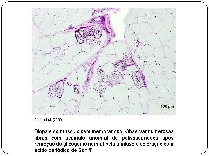 Finno et al. (2009) Biopsia do músculo semimembranoso. Observar numerosas fibras com acúmulo anormal