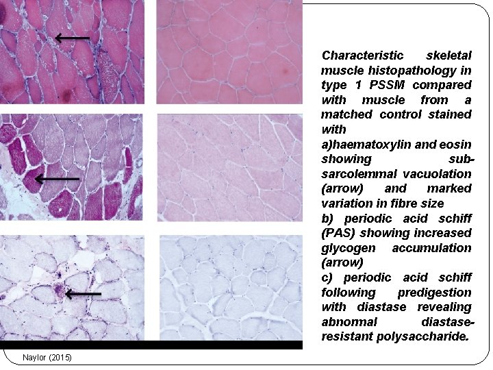 Characteristic skeletal muscle histopathology in type 1 PSSM compared with muscle from a matched