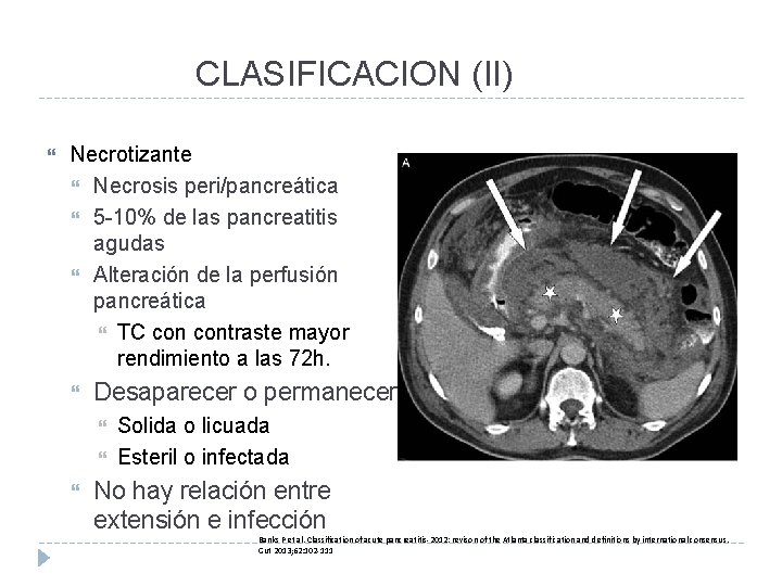 CLASIFICACION (II) Necrotizante Necrosis peri/pancreática 5 -10% de las pancreatitis agudas Alteración de la