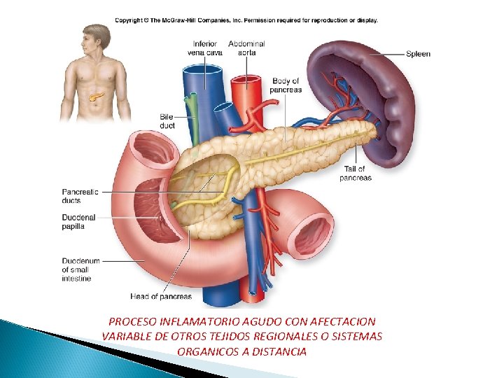 PROCESO INFLAMATORIO AGUDO CON AFECTACION VARIABLE DE OTROS TEJIDOS REGIONALES O SISTEMAS ORGANICOS A