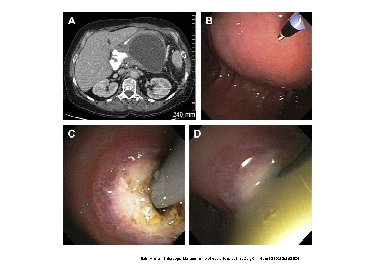 Bahr M et al. Endoscopic Managemento of Acute Pancreatitis. Surg Clin N am 93