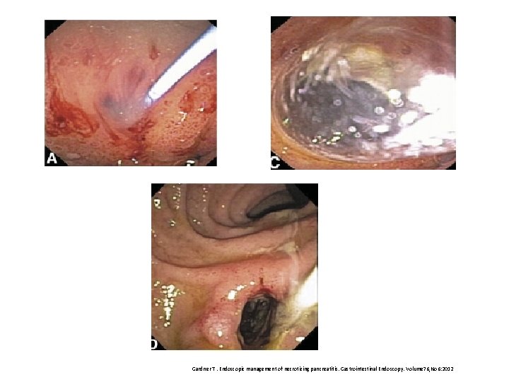 Gardner T. Endoscopic management of necrotizing pancreatitis. Gastrointestinal Endoscopy. Volume 76, No 6: 2012