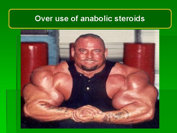 Over use of anabolic steroids Over use of anabolic steroids