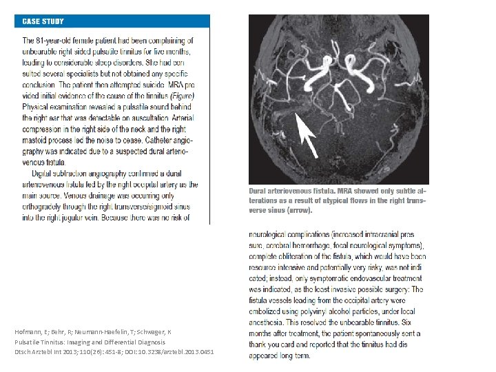 Hofmann, E; Behr, R; Neumann-Haefelin, T; Schwager, K Pulsatile Tinnitus: Imaging and Differential Diagnosis