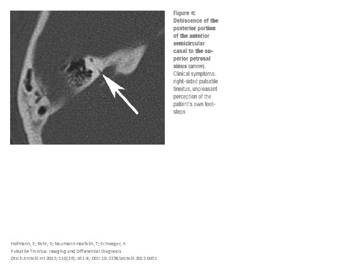 Hofmann, E; Behr, R; Neumann-Haefelin, T; Schwager, K Pulsatile Tinnitus: Imaging and Differential Diagnosis
