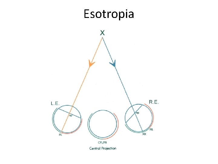 Esotropia 