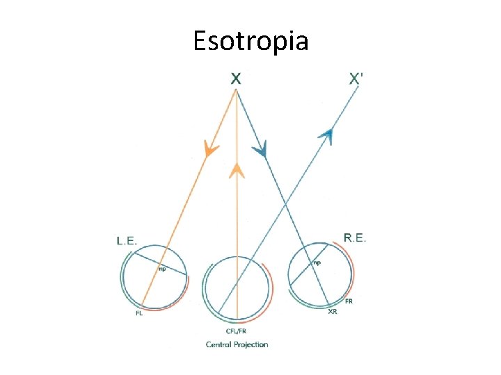 Esotropia 