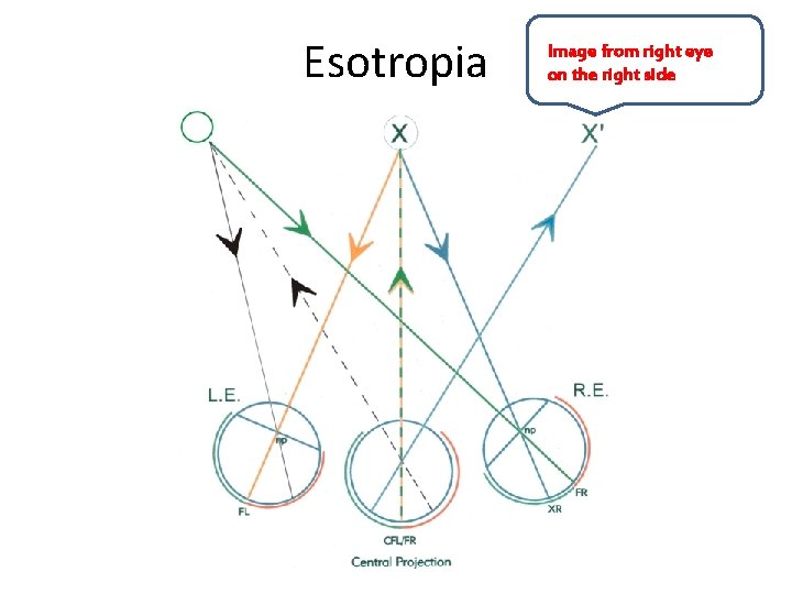 Esotropia Image from right eye on the right side 