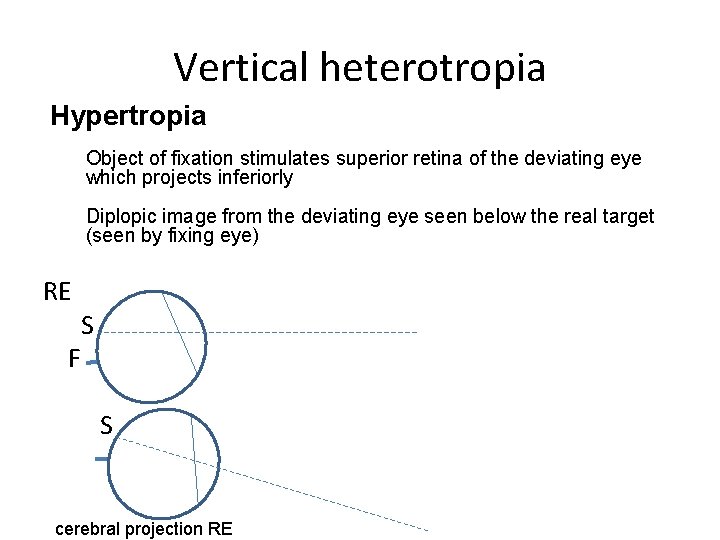Vertical heterotropia Hypertropia Object of fixation stimulates superior retina of the deviating eye which