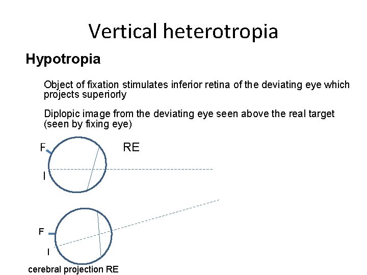 Vertical heterotropia Hypotropia Object of fixation stimulates inferior retina of the deviating eye which