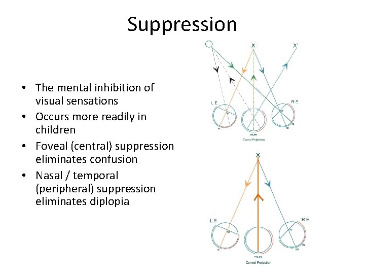 Suppression • The mental inhibition of visual sensations • Occurs more readily in children
