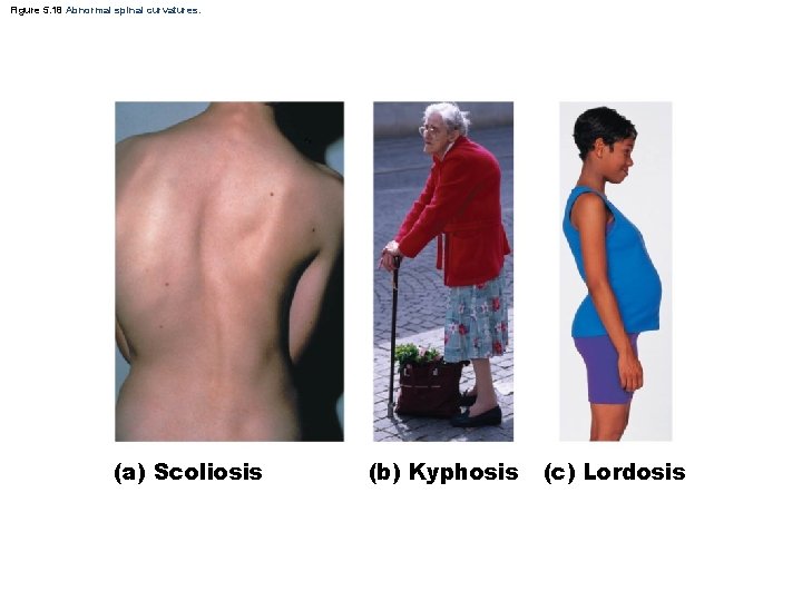 Figure 5. 18 Abnormal spinal curvatures. (a) Scoliosis (b) Kyphosis (c) Lordosis 