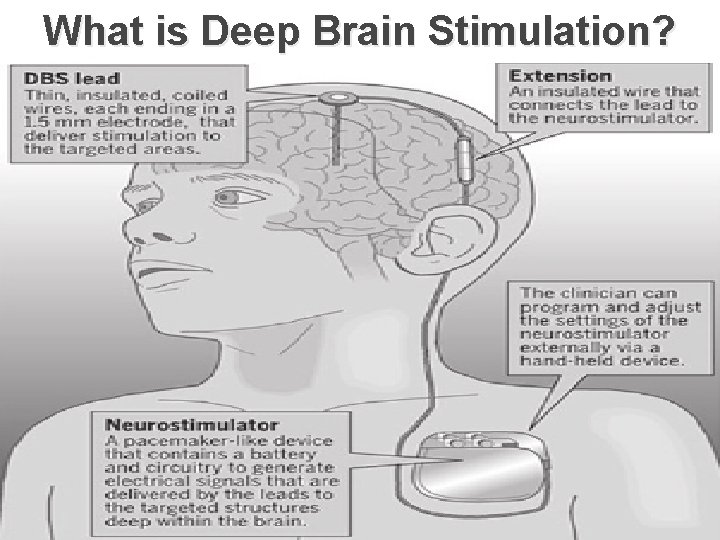 What is Deep Brain Stimulation? 