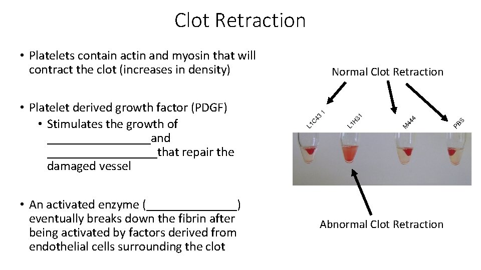 Clot Retraction • Platelets contain actin and myosin that will contract the clot (increases